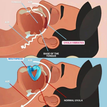Balancezia™ - Mouth Guard